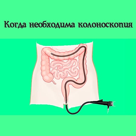 Колоноскопия в Алматы